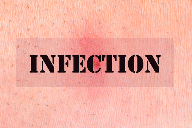 The word infection over human skin background.